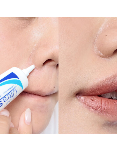 Vitara Ultra Silicone Scar 9g - 2