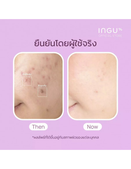INGU Anti Acne Toner Mist - 3